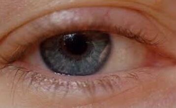 Blefaritis curada con Oculax